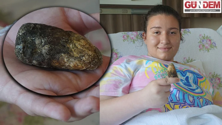 Hastanın safra kesesinden çıkan taş doktorları şaşkına çevirdi