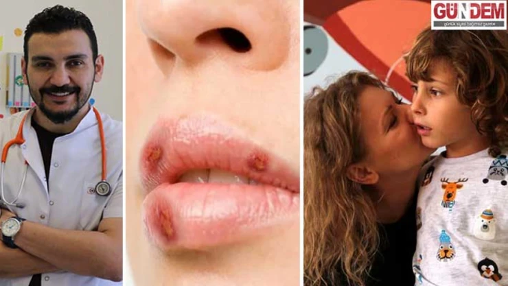 Herpes virüsü nedir ? Zararları nelerdir ?